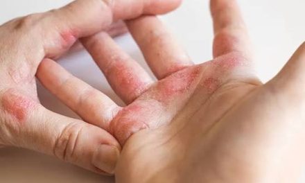 Penyakit Kusta: Penyebab, Gejala, Dan Cara Pencegahannya
